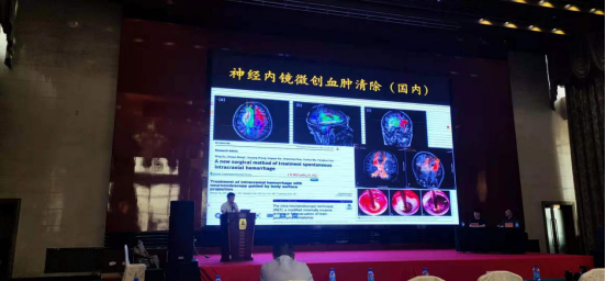 热烈庆祝中国神经内镜微创治疗高血压脑出血技术推广会顺利召开